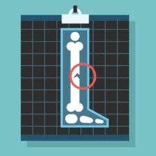 Illustration of broken bone in leg; can't play sports