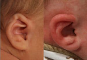 earprocedure4300x2101