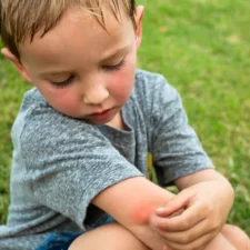 iStock image of People with a little boy with a red mosquito bite on his elbow, outdoors in the grass