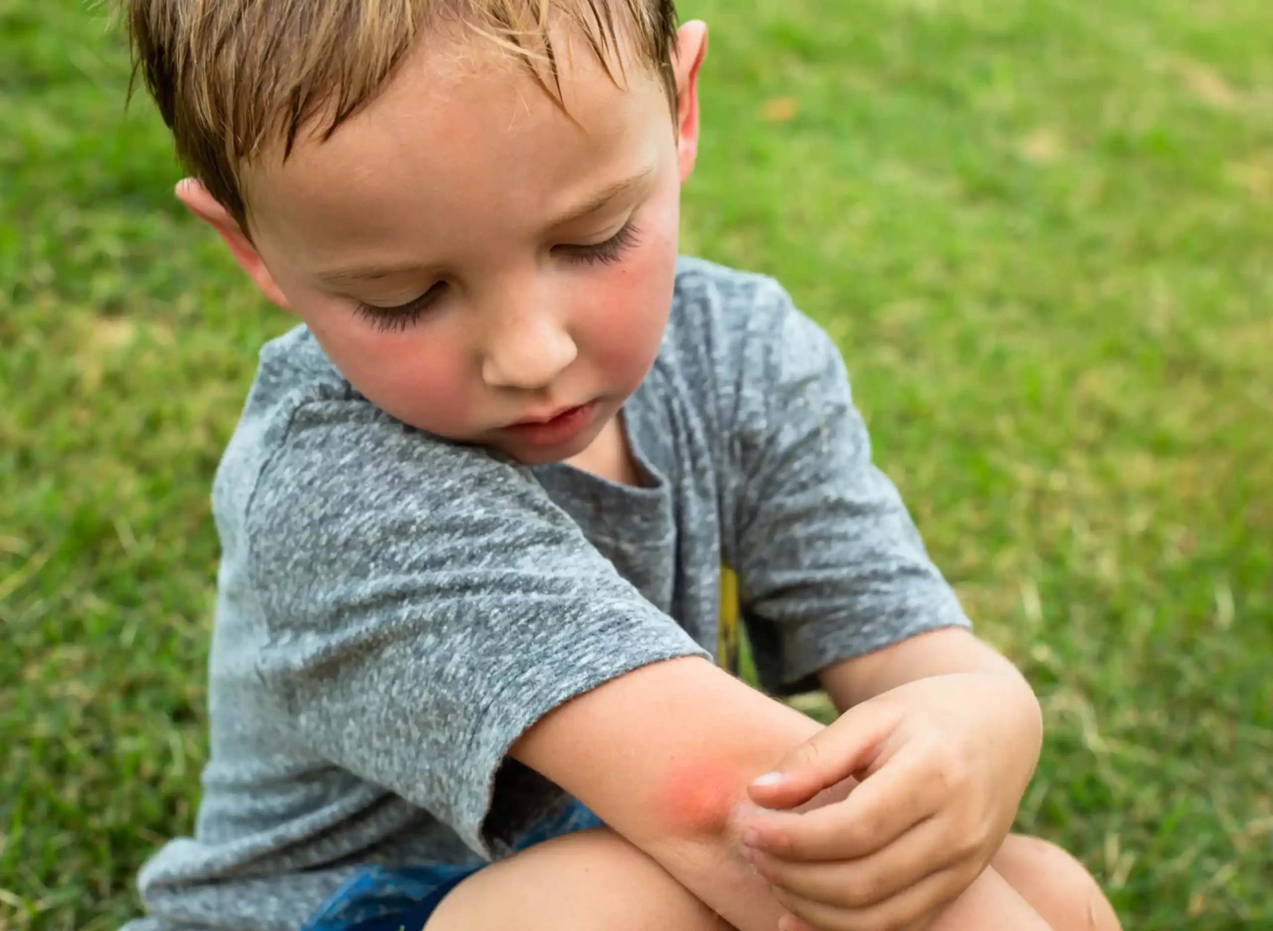 iStock image of People with a little boy with a red mosquito bite on his elbow, outdoors in the grass